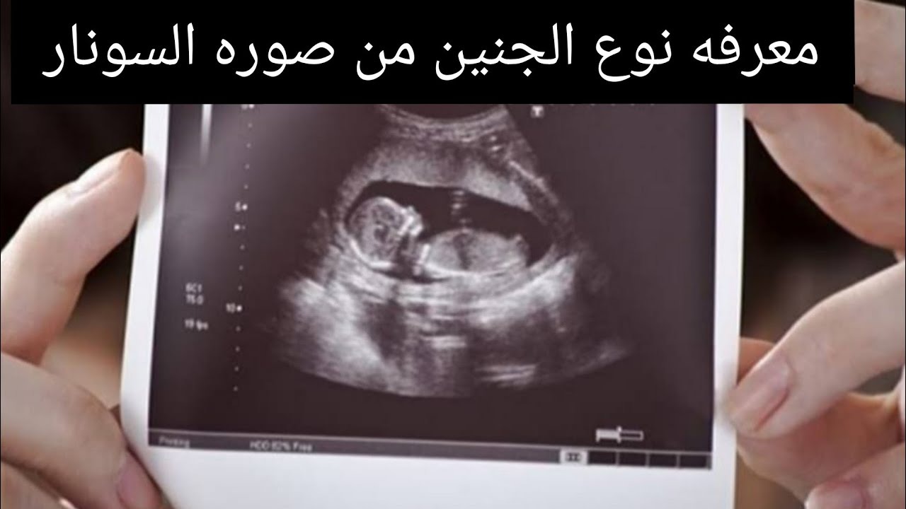 حمل الولد: شكل الجنين الذكر في الشهر الثالث بالسونار